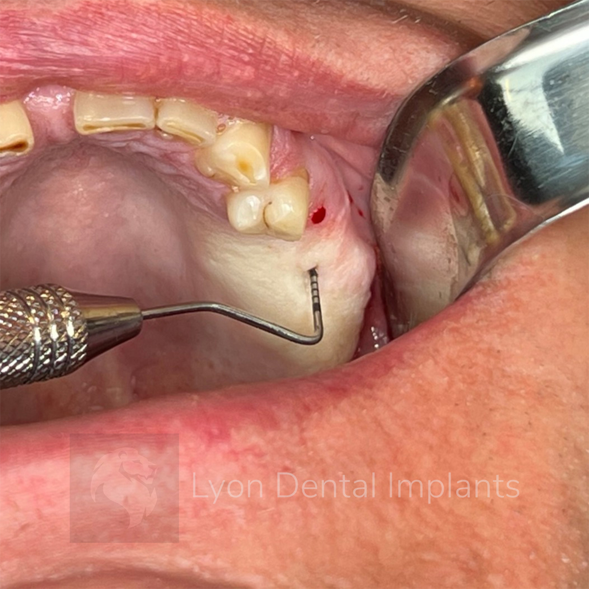 UNC15-probe-minnesota-cheek-retractor-logo